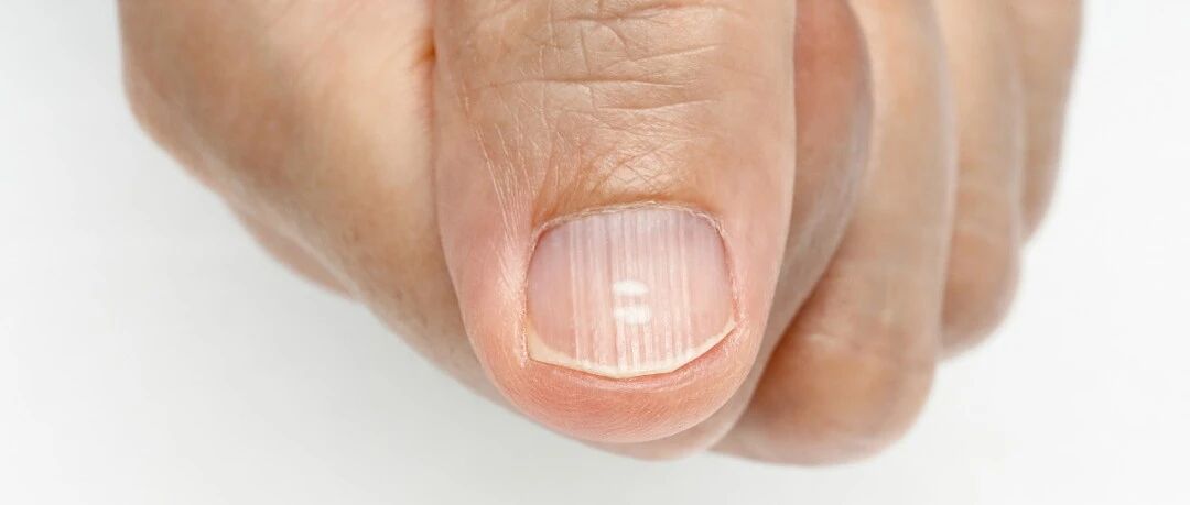 指甲起竖纹是肠胃不好？指甲“月牙”越多越健康？真相来了