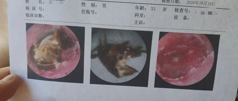 睡梦中蟑螂钻进耳道，广东33岁男子又拍头又用水冲，不料蟑螂死在了里面，一周后得知耳膜险些穿孔，现在听人说话感觉很小声